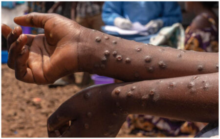 Trois morts en 24h : Attention à la fièvre de la Vallée du Rift Trois morts en 24h : Attention à la fièvre de la Vallée du Rift