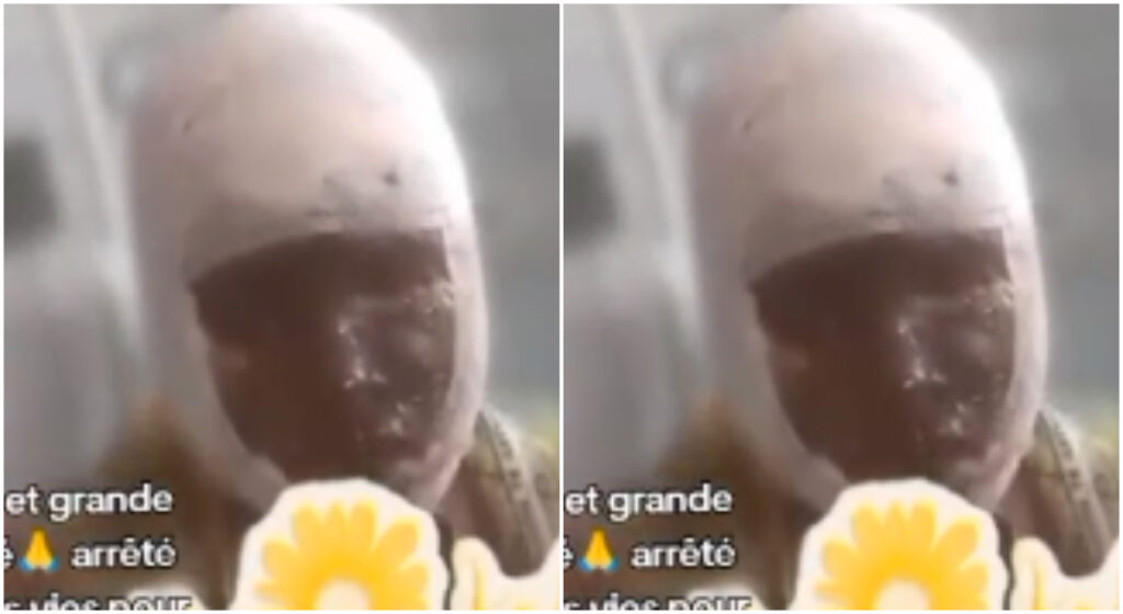 Jalousie mortelle : une femme verse de l'acide au visage de la compagne de son ex